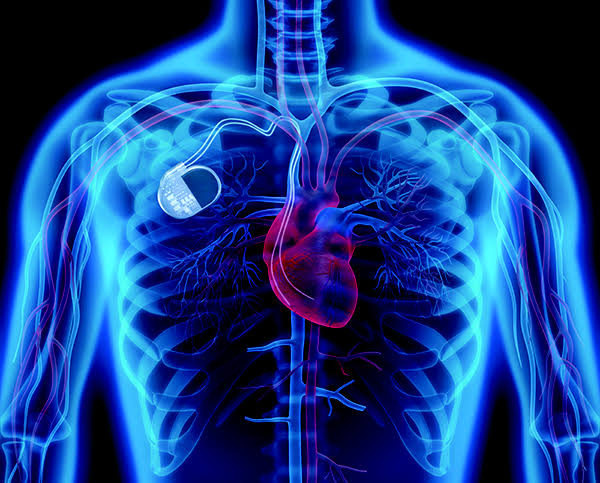 medical implants